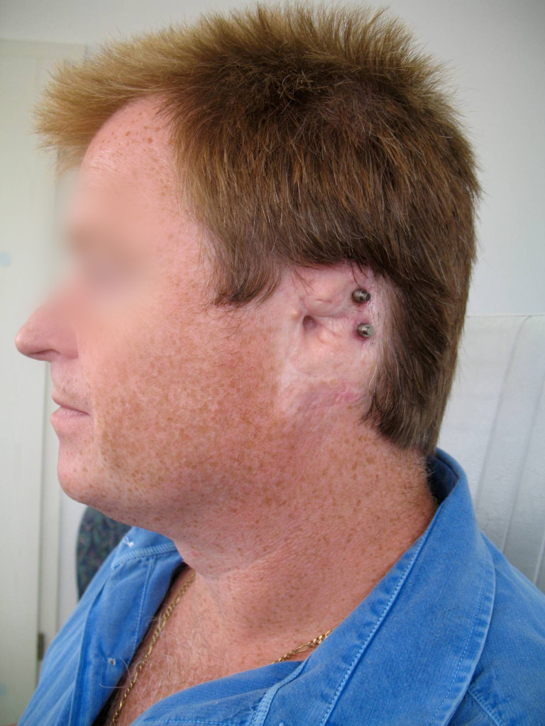 Ohrepithese Institut für Anaplastologie