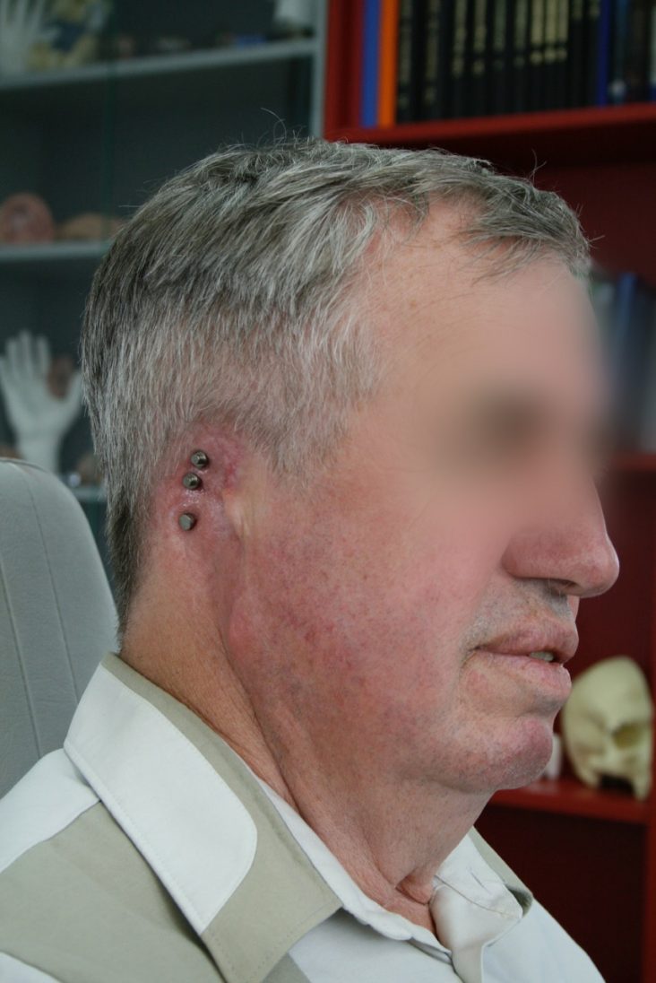 Ohrepithese Institut für Anaplastologie